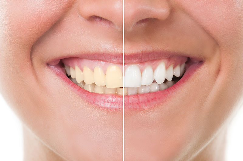 Teeth Whitening - Leonard Espinosa DMD Inc, Long Beach Dentist